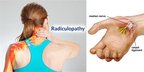 double crush syndrome test|double crush syndrome signs.